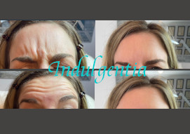 Botox frown
