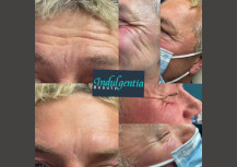 Botox eyes male