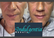 Dermalfiller Naso